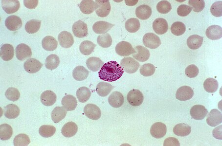 Blood cervical smear parasit