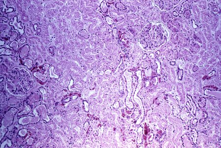 Kidney patient sample
