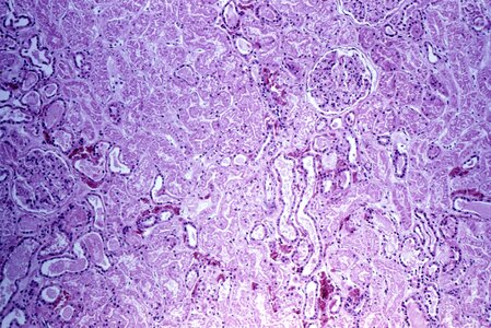 Kidney patient sample photo