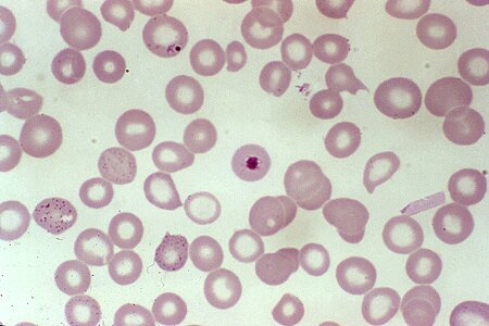 Blood cervical smear development photo