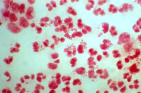 Exudate gram negative