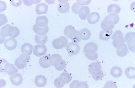 Blood cervical smear form photo