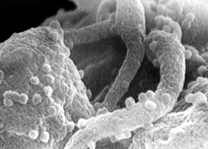 Disease electron micrograph lymphocyte photo