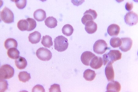 Blood cervical smear reveal photo