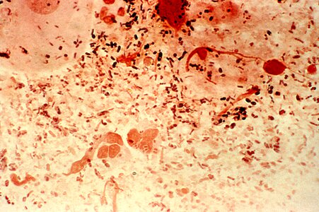 Bacteria gonorrhea gram photo