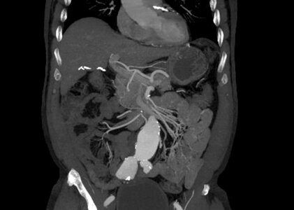 My abdominal aorta and iliac artery aneurysms photo