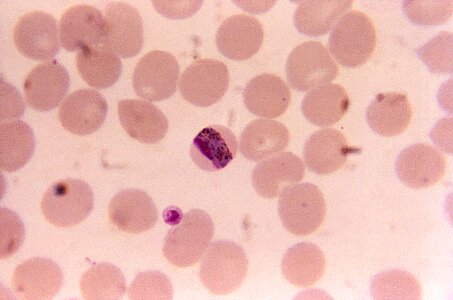 Band blood cervical smear photo