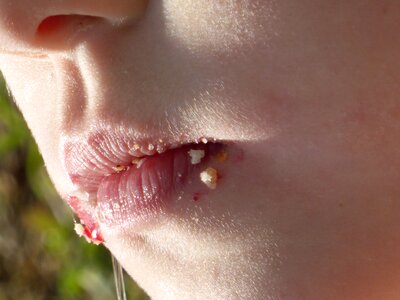 Child's mouth skin face