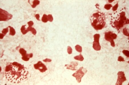 Diagnosis gonorrhea leading