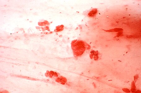 Bacteria cervical smear gram photo