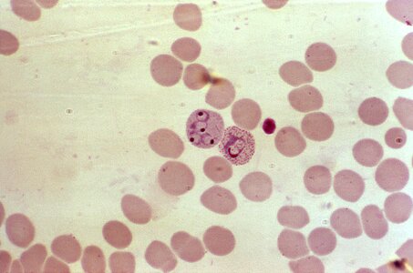 Blood cell crescent photo