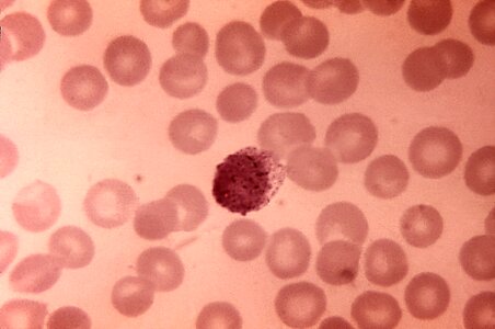 Blood cervical smear photomicrograph