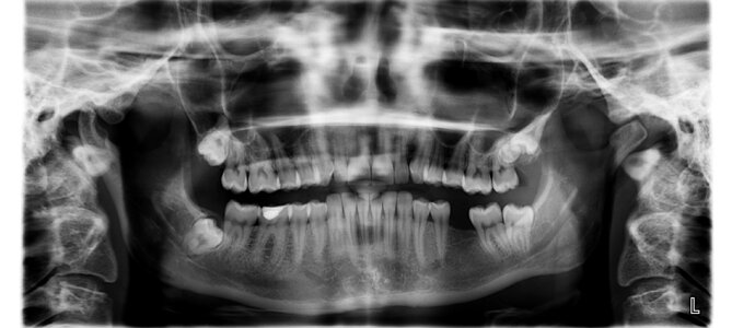 X ray teeth tooth missing photo