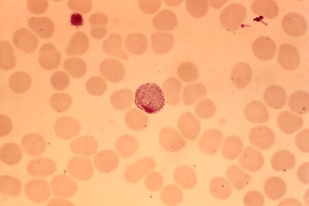 Blood cervical smear photomicrograph