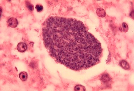 Histopathology liver malaria