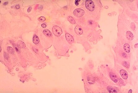 Gallbladder histopathology photo