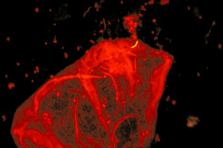 Counterstain orange tuberculosis