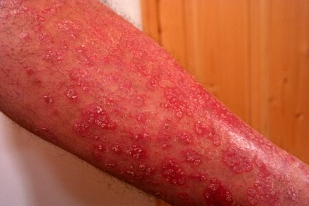 Scaly skin inflammatory skin disease