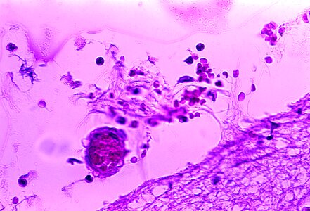 Bacillus meningitis photo