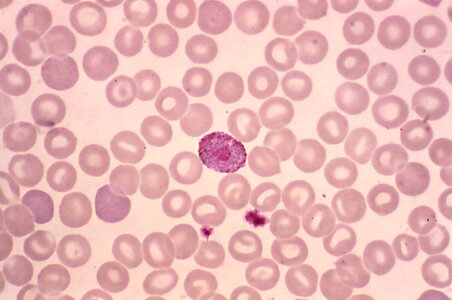 Blood cervical smear photomicrograph