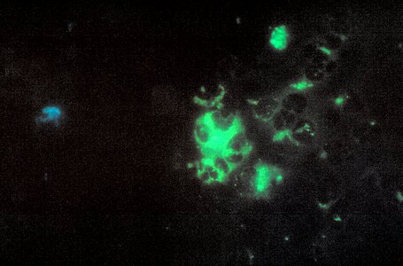 Brain cervical smear impression