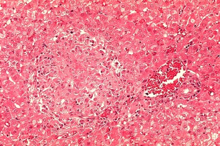 Area granuloma infection