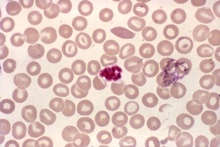 Blood cervical smear scrub photo