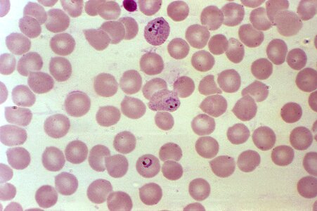 Blood cervical smear photomicrograph