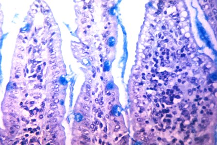 Biopsy causing production