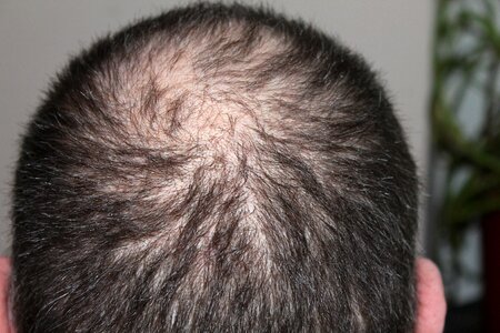 Man hair loss head