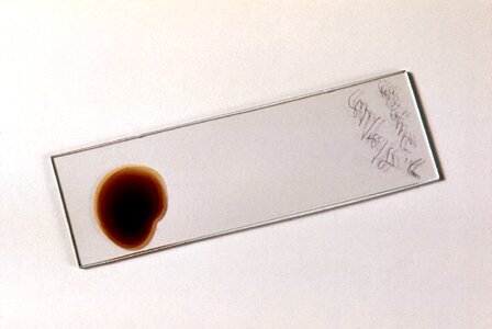 Appearance blood cervical smear