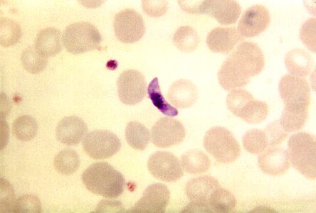 Blood cervical smear parasit