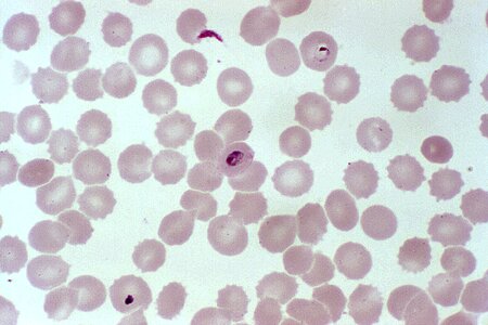 Blood cervical smear photomicrograph photo