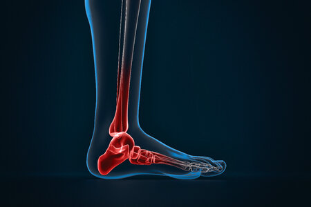 Arthritis of ankle. X-ray of foot. Lateral view photo