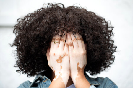 Woman with vitiligo photo