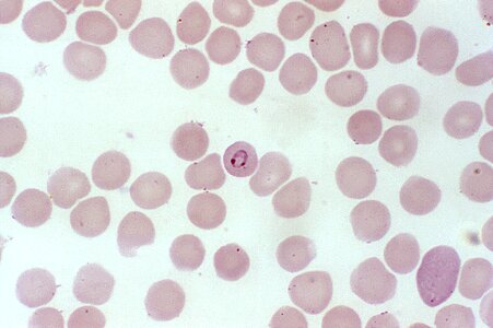 Blood cervical smear photomicrograph photo