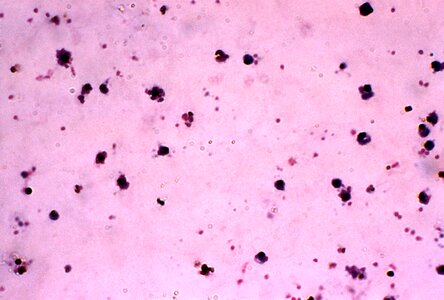 Blood cervical smear dinky