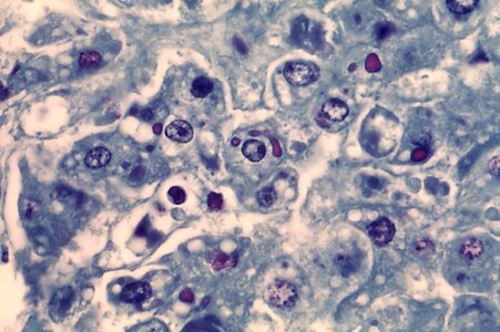 Fever hemorrhagic fever human