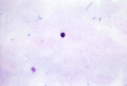 Crescent gametocyte plasmodium