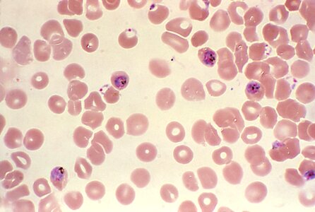 Blood cervical smear dinky