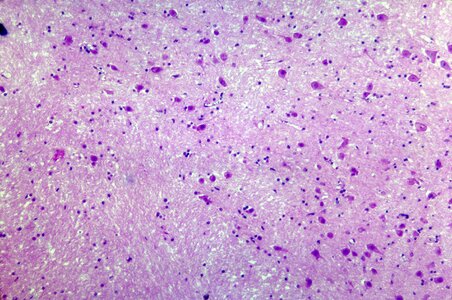 Brain histopathology malaria photo