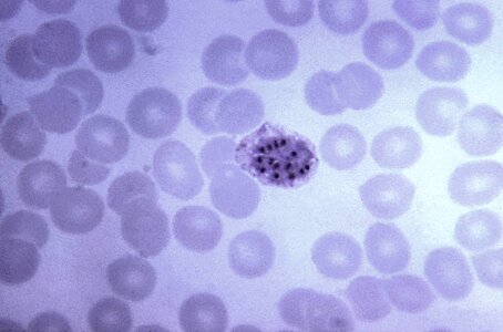 Blood cervical smear chromatin photo