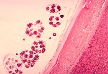 Cyst echinococcus histopathology photo