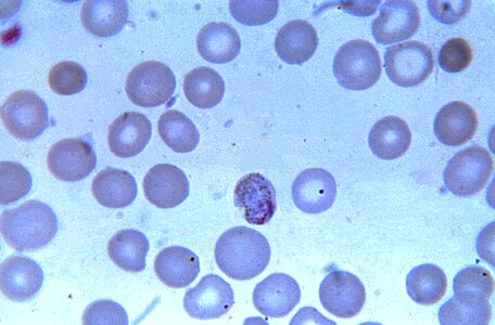 Chromatin cytoplasm irregular