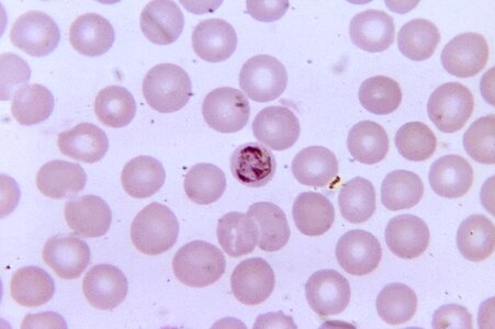 Blood cervical smear chromatin photo