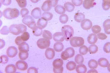 Blood cervical smear crescent photo