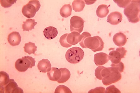 Blood cervical smear plasmodium
