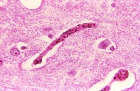 Brain histopathology malaria