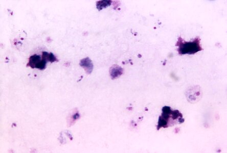 Cervical Smear crescent film