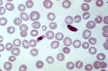 Blood cervical smear macro